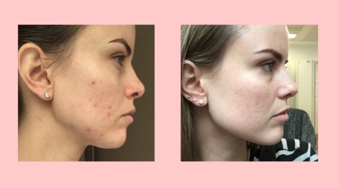 Sometimes a loss can be a gain- learn how giving up milk can smooth skin via <a href="/marieclaireuk/">Marie Claire</a>
bit.ly/2lvtDcD