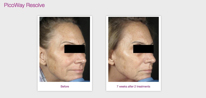 PicoWay Resolve® patients experience incredible results after only a few treatments! Check out  patient results at: bit.ly/2lTMXk3