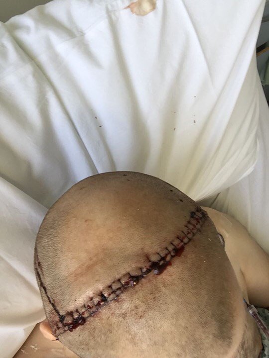 My friend Alex got hit in the face by a cricket ball,15 broken bones in his face,he has a young family to support,justgiving.com/crowdfunding/A…