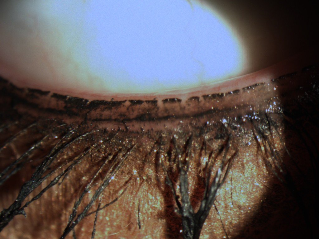 Avoid the #waterline with #mascara. This can harm your #eye oil glands. #dryeye #optometry #aesthetics