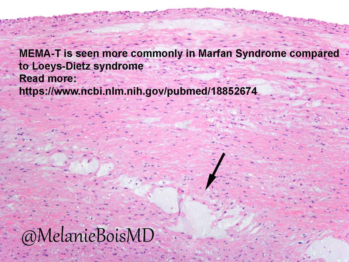 MelanieBoisMD's tweet photo. Aortic translamellar mucoid extracellular matrix accumulation (MEMA-T), seen with increased freq in Marfan Syndrome #MayoCVpath #CardiacPath https://t.co/w0Ujs0Ik34