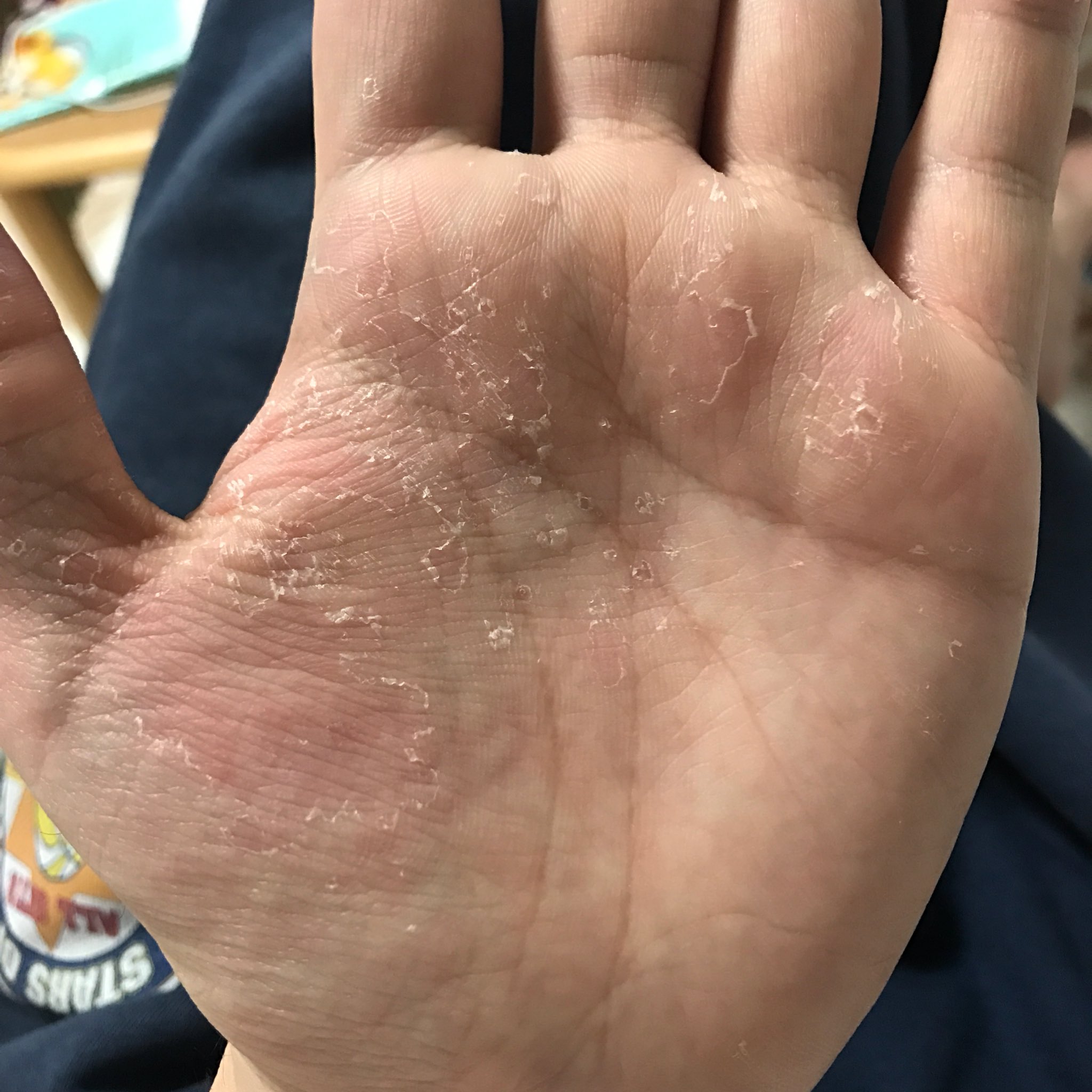 Fuminari 最近風呂上がりに手だけ皮がボロボロ剥ける 別に乾燥肌とかではないのに 引く 笑 Fuminari 最近風呂上がりに手だけ皮がボロボロ剥ける 別に乾燥肌とかではないのに 引く 笑