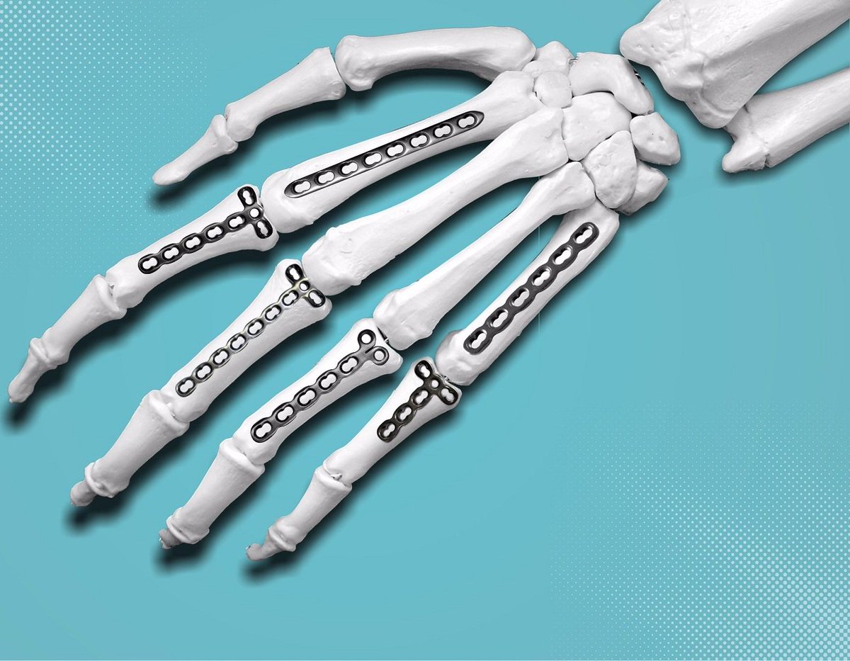 siorasurgicals's tweet image. #LCP - #LockingCompressionPlate which is used for fixation of fractures especially osteopenic bone. goo.gl/hn0YAY