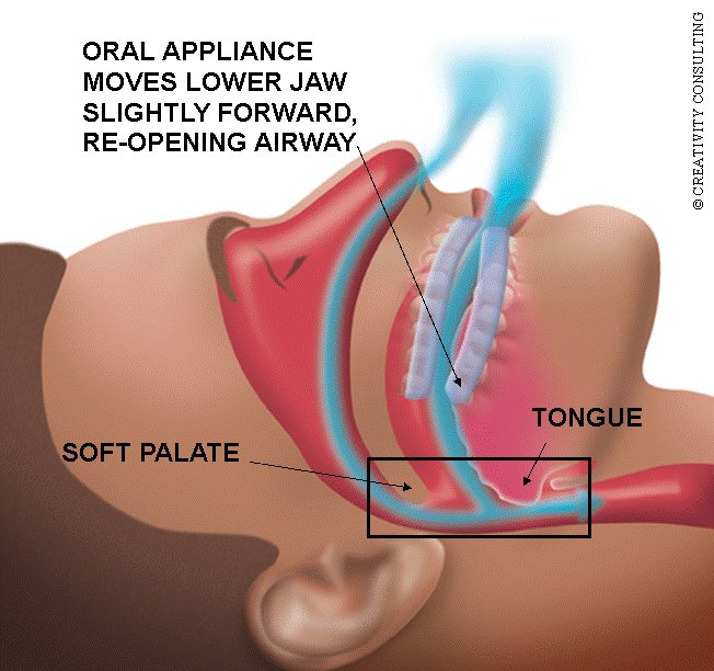 CypressDental's tweet image. #sleepapneadentaldeviceincovina #sleepapnea #snoringproblem #excesssnoring #sleepproblems… covinadentaloffice.com/blog/index.php…