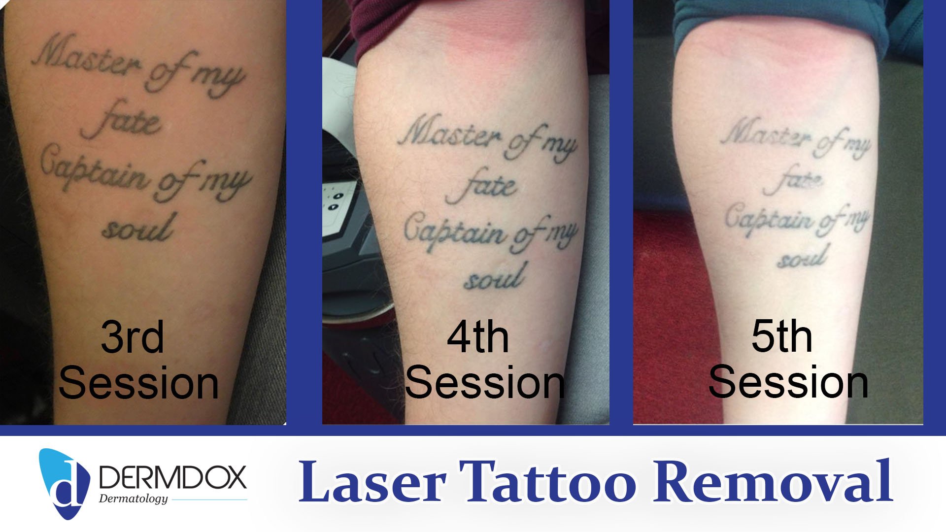 Pictures  Process  Sage Laser Tattoo Removal
