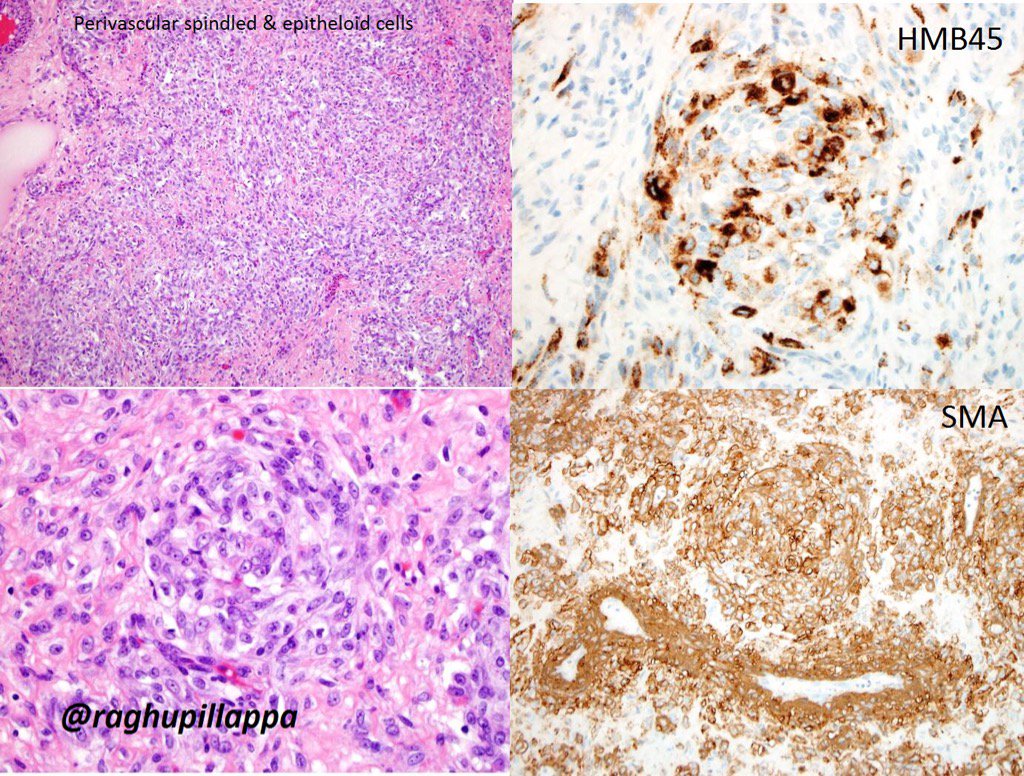 raghupillappa's tweet photo. Uterine mass -PECOMA #gynpath #bstpath @JMGardnerMD @GynPath @gynecopatho @NRiddleMD @kriyer68 @Konzult_ @JL_Sauter https://t.co/Mlqi2bi4vt