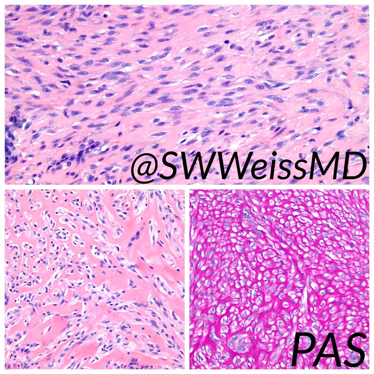 Sharon Weiss (@swweissmd) on Twitter photo A beautiful case of juvenile hyaline fibromatosis with cellular and classic areas. #bstpath <a href="/jmgardnermd/">Jerad Gardner, MD</a> A beautiful case of juvenile hyaline fibromatosis with cellular and classic areas. #bstpath <a href="/jmgardnermd/">Jerad Gardner, MD</a>