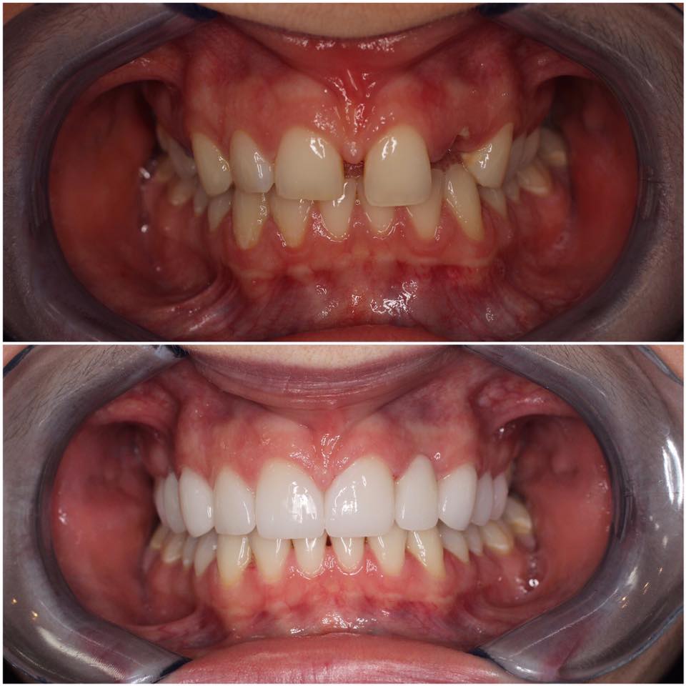 DDDentistry's tweet photo. Another amazing #transformationtuesday by Dr. Daniel!! #Halifax #ILoveLocal #HalifaxDentist #smilemakeover #danieldanieldentistry https://t.co/ExMHvjJQK8