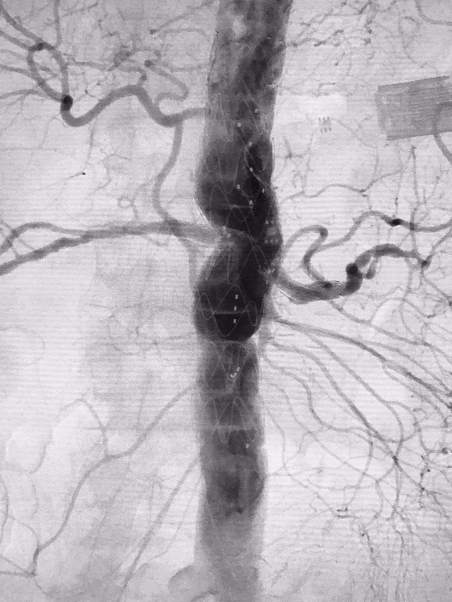 4- vessel CMD FEVAR for treatment of type 4 thoracoabdominal aneurysm in our IDE study. That's how we roll! <a href="/WeillCornell/">Weill Cornell Medicine</a> <a href="/nyphospital/">NewYork-Presbyterian</a>