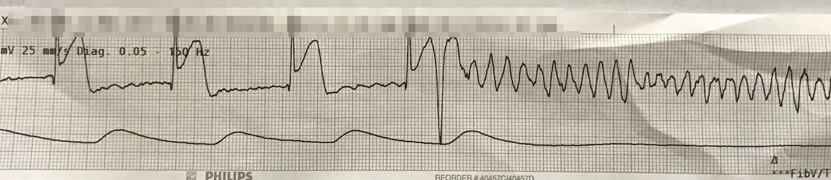 umanamd's tweet image. My least favorite thing to see on an ECG trace...
#codeSTEMI #EMimages
#Shock