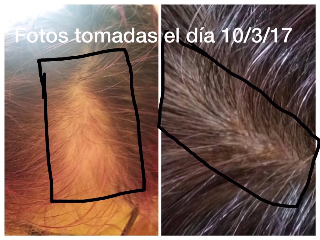 lluna422's tweet photo. #DorannaHairStylingRivieraMaya Te gustan las mantas?#VasATenerLaMejor .Así tengo aún mi cabeza,#Quemada .Sigues sin 🏦el daño que me has ✅😭😭😡 https://t.co/cohpUg73PK