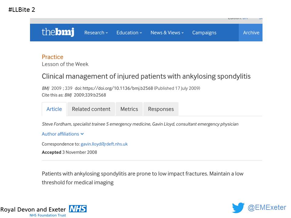 EMExeter's tweet photo. #LLBite Ankylosing Spondylitis - have a very low threshold for imaging even if minor mechanism of spinal injury https://t.co/Y0037U50oj