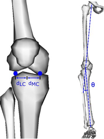 JBiomech's tweet photo. Sensitivity of Medial and Lateral Knee Contact Force Predictions to Frontal Plane Alignment and Contact Locations
https://t.co/kbIq7sPI4K https://t.co/5roD9K4Go5
