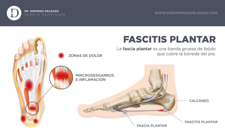drddelgado's tweet photo. ¿Tú también eres fanático del #running? Entonces, seguro que has oído hablar de la molesta #fascitis plantar https://t.co/aKk4RQopvx https://t.co/OnIfG3UfH6