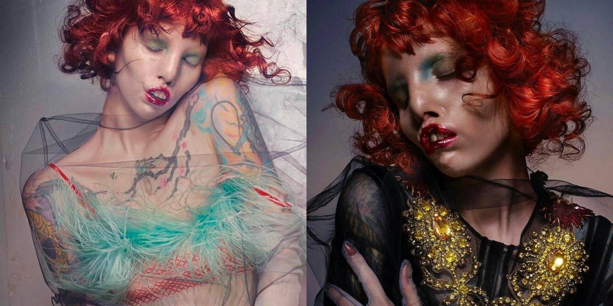 ELLE Magazine (US) on Twitter "Model born with "Cat Eye Syndrome