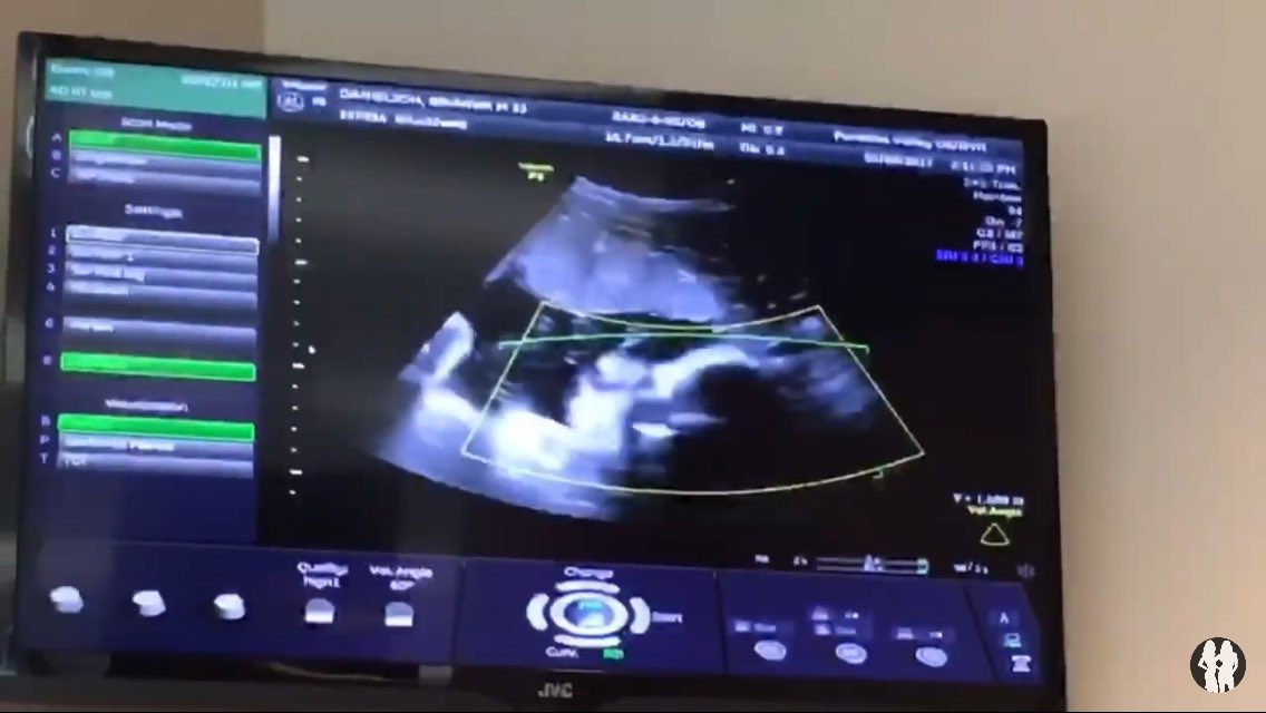 RavishingHippie's tweet photo. Yesterday we went for my last ultrasound to see Birdie one last time till she arrives. https://t.co/HL84wrSt7J