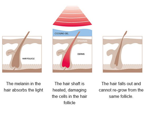 Looking for permanent #HairRemoval? #IPL might be just the thing you need! #Brighton #Beauty ow.ly/RJXd309sfqA