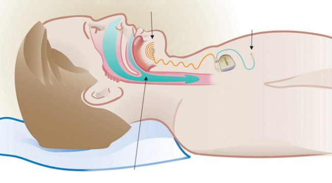 A new alternative for patients w/ obstructive sleep apnea who do not tolerate CPAP cle.clinic/1Mgf0CK