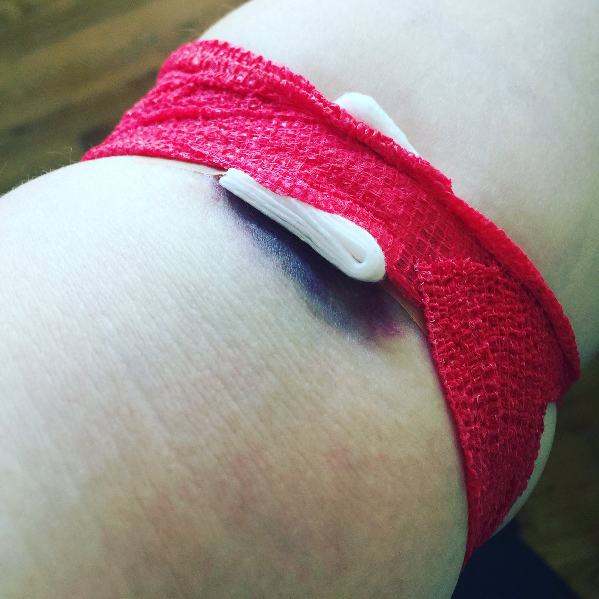 Rupiejane's tweet image. Had an itch on my arm, but I was #donatingblood #platlets both your and have needles in them. Whoops! #redcross don't bend your arms!!