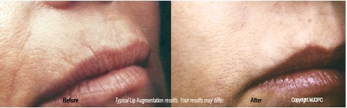 docchecker's tweet image. LIP AUGMENTATION
Contact us 
MANHATTAN OFFICE
1000 Park Avenue 
New York, NY 10028
Call: 212-288-1300
klingderm.com/lip-augmentati…