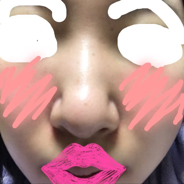 ぴか On Twitter 鼻のbefore After 術後1ヶ月 です チップトック 小鼻縮小しました 鼻の穴に少し左右差ありますが 普通に鏡で見る分には全く気にならないです 真下から見ると手術跡が残ってます Https T Co Rgs9u8q2x8 Twitter
