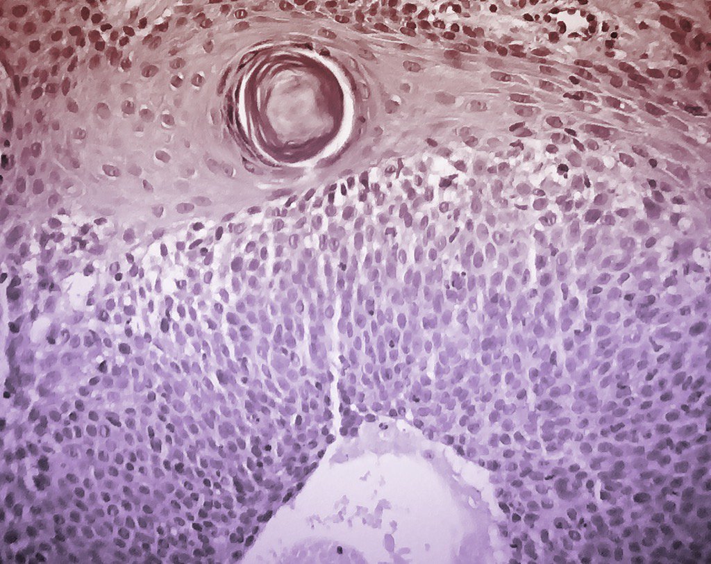 Philipp66640561's tweet photo. #dermpath #pathology #dermatology  Cyst and pseudocyst in clonal ks https://t.co/Fk7kNtTwvI