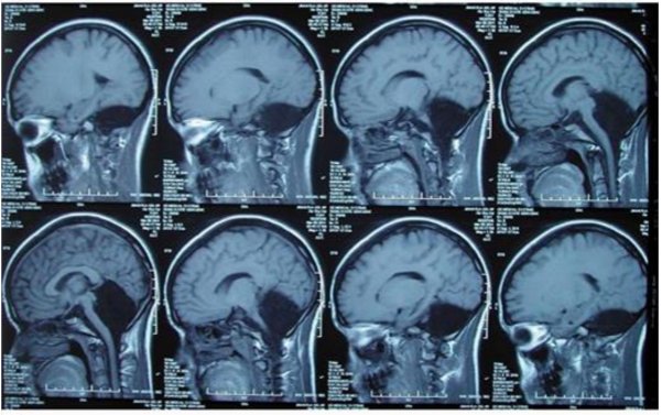 Extremely rare case of a living patient without a cerebellum 
bit.ly/2m5oQPK via <a href="/MattNeuro/">Matthijs Dorst</a>