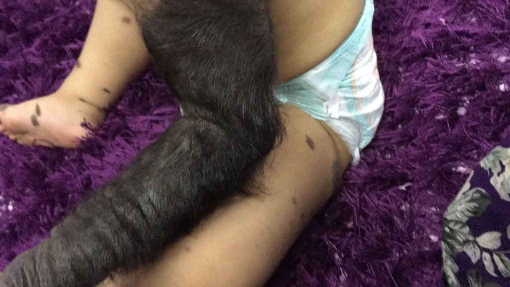 الطفلة عمرها سنة ونصف وتحتاج لتدخل جراحي عاجل، حالتها لايمكن علاجها بالسعودية، مرفق تقرير مترجم لحالتها .
#الطفلة_حور_تناشدكم_العلاج