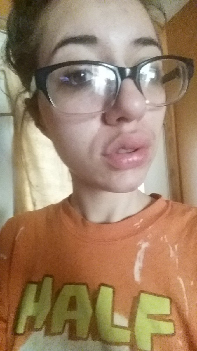 Freak77Show's tweet photo. So I got botox today what do you think?
So kidding, bit my lip last night and woke up like this...
#botchedbotox https://t.co/akkDUsKJqX