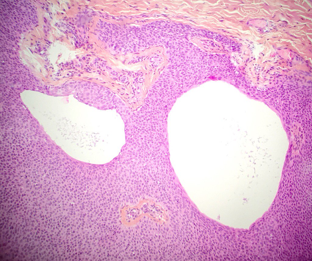 Philipp66640561's tweet photo. #dermpath #pathology #dermatology.    Cysts of an eccrine poroma https://t.co/5BlRXigYZz