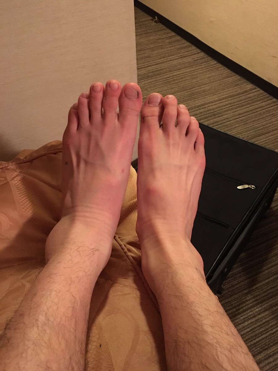 爆裂ヒットマン 会社研修で 女の先輩の前でカッコつけて重い荷物運んでたらあまりに重すぎて 西野カナの別れた元彼を想う想いよりも重すぎて 足元もつれてびっくりするくらい捻挫した 左足首が腫れ渡ること山の如しなんだけど誰かもう俺のこと殺してくれ