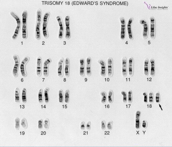 lilacinsights's tweet image. Edwards' syndrome, also known as Trisomy 18, is a serious genetic condition caused by an additional copy of chromosome 18.
#edwardsyndrome