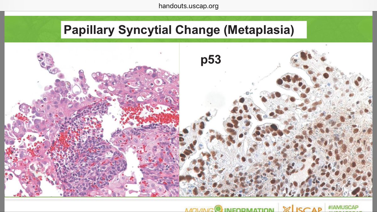 JNStallMD's tweet photo. Papillary syncytial metaplasia can have strong but still wild type p53. Don't mistake for serous CA! #USCAP2017 #gynpath https://t.co/RbpOPkv86X