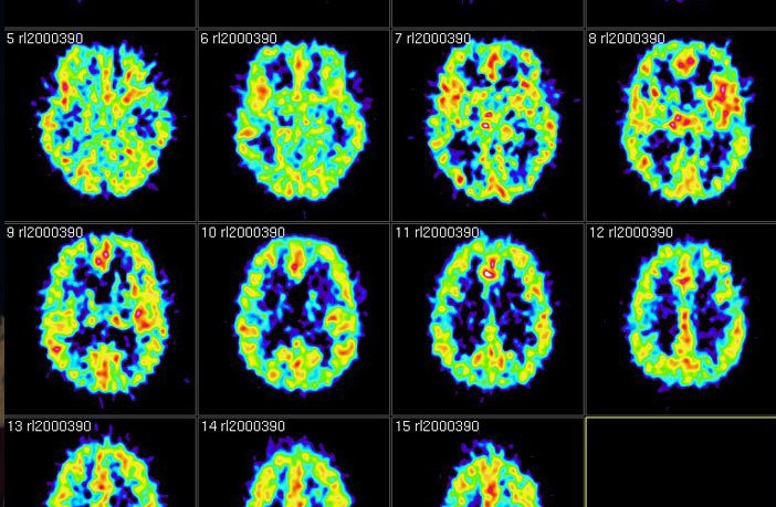 SSRISupport1's tweet photo. Air pollution exposure may increase risk of dementia https://t.co/2Z2Zcom2zm https://t.co/k0vlyJGyVV