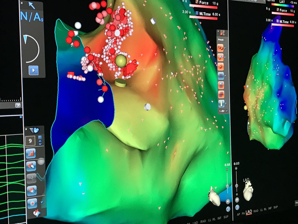 atypicalflutter's tweet image. Not very clean but there! Thanks @DrFerminGarcia @aalahmadmd @ALFIEEP1 @jonascooperEP
