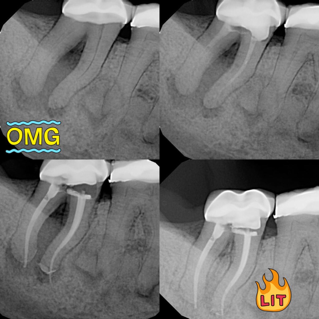 DrRicoShort's tweet photo. Case Of The Day!
Extract & Implant or Save?
Perio-Endo?
Root canal done in 2 visits with CaOH. Healing in furcation at 6mo!
#RootCanalsRock https://t.co/BCBX2jsRtc