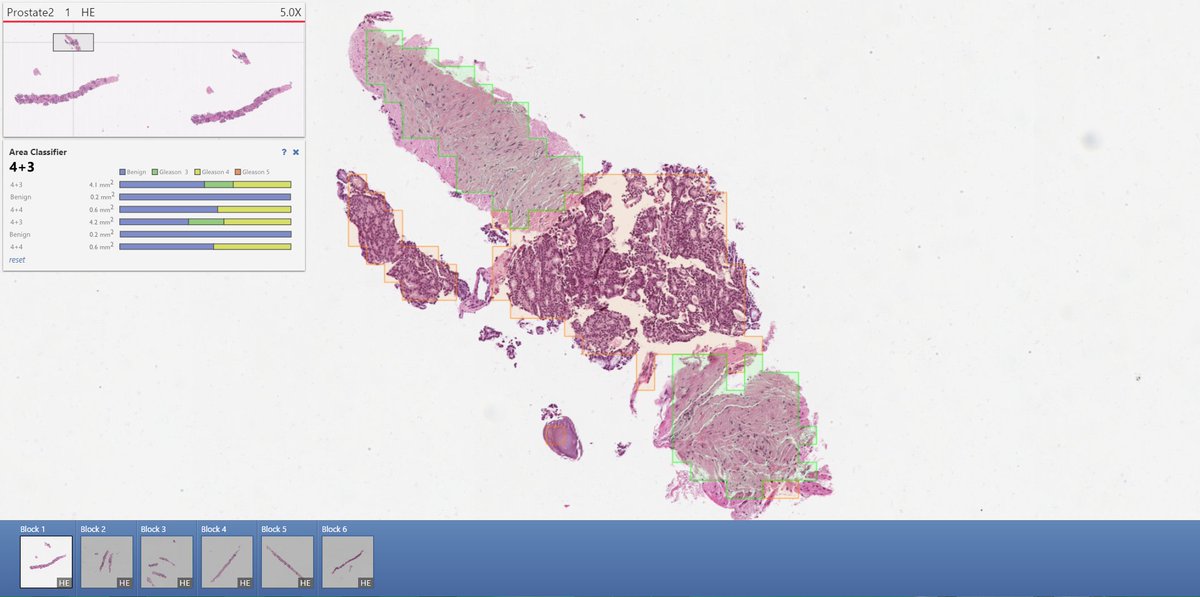 SectraNews's tweet image. Will not using image analysis in #digitalpathology be perceived as irresponsible? bit.ly/2mWp2ka  #USCAP2017 #digpath @simon_haeger