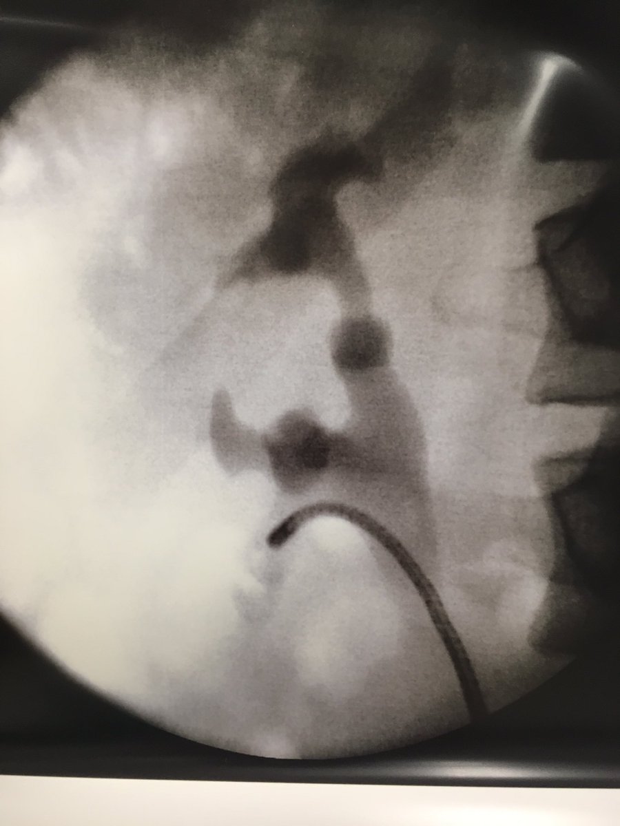 rnpedro_URO's tweet photo. collecting systems are always a beautiful and unique surprise, each one has your own. never the same #kidneystone #RIRS #flexURS https://t.co/h29pRlKKFM