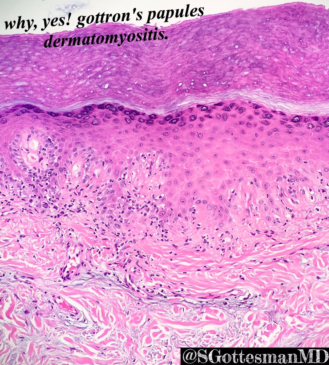 Do I have a treat for you guys... myositis and dorsal fingers lesions. #pedipath #dermpath #dermatology #gottron's papules #dermatomyositis