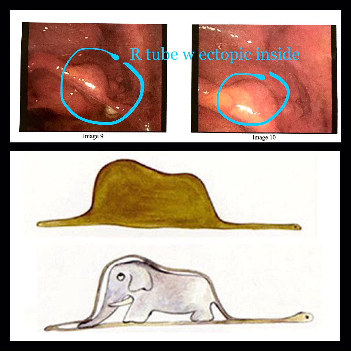 LegaLess's tweet photo. I don't know if anyone's still here but I had a tubal #ectopicpregnancy  removed that looks like Le Petit Prince's elephant-in-snake hat. https://t.co/xlHUThmIPh