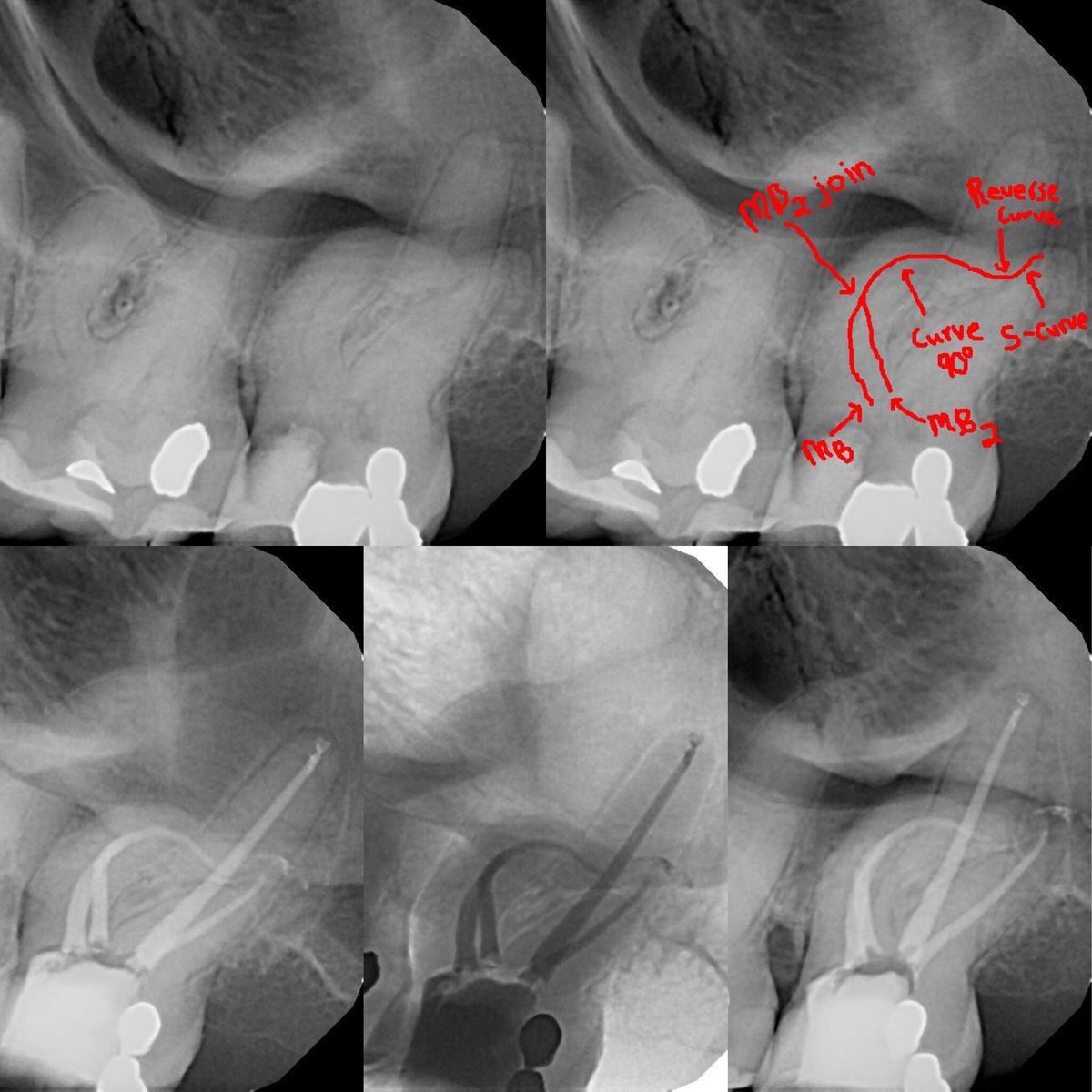 DrRicoShort's tweet photo. Case Of The Day!
Severe Canal Curvature...
The @EdgeEndo X7/.04 21mm came to party hard!
#RootCanalRockStar
#RelaxDontExtract
#TakeThatCurve https://t.co/BES1qZqIYL
