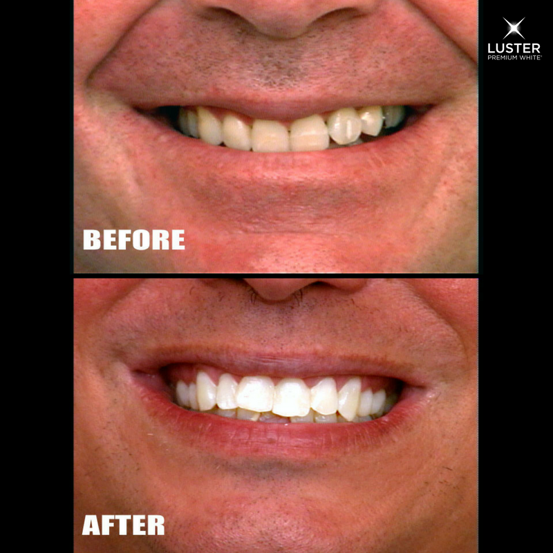 LusterPremWhite's tweet image. Calling all dudes! Simplify your routine with our powerful at home whitening kits. #MensGrooming #SimpleRoutine #TheLusterWay