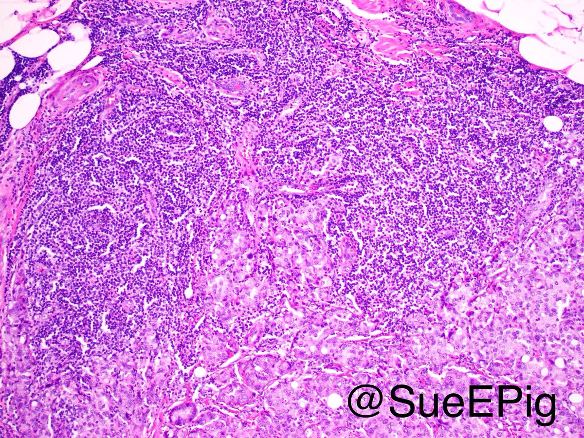 SueEPig's tweet photo. Medullary carcinoma? If not, why? #breastpath #hartfordpath #lookaliketumor #lymphoepithelialcarcinoma https://t.co/vM3LqcUubn