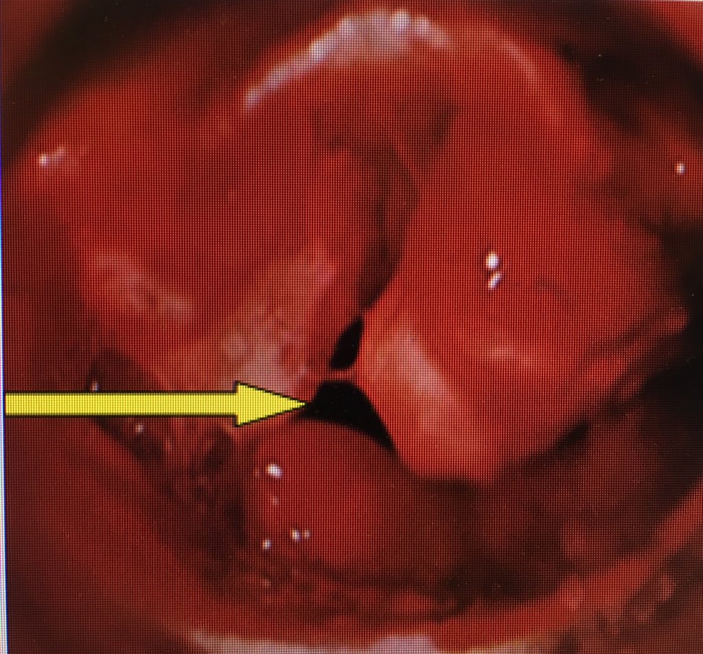 <a href="/ketaminh/">Fred</a> <a href="/QxMD/">QxMD | Your Personalized Medical Journal</a> <a href="/NaveenEipe/">Dr. Naveen Eipe, MD</a> this is image of laryngeal fracture. Arrow indicates trachea <a href="/HansvanSchuppen/">Hans van Schuppen</a> @victor_viersen <a href="/RAVG_V/">Educatie RAV G&V</a>