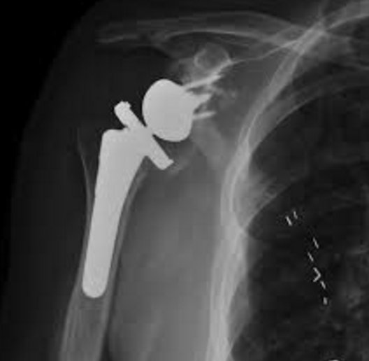 druginjuryatty's tweet photo. What Is The Reverse Shoulder Implant? https://t.co/ifDeq6eav0 #DefectiveDevice #MedicalDevice https://t.co/haTYybMEzT
