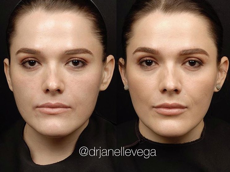 MayoralDerm's tweet photo. Our aesthetician Tatjana restored volume in her cheeks with #RestylaneDefyne & created a fuller, more dramatic pout using #RestylaneSilk. https://t.co/4CiCuYAWMH