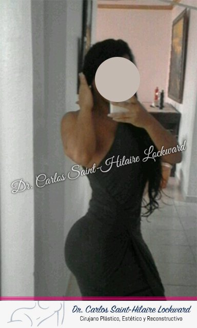 Ella está feliz con su resultado. Whatsapp 1-849-919-3655 #CirujanoPlástico #DrCarlosSaintHilaireLockward #bodymaker #siluet #Esthetic