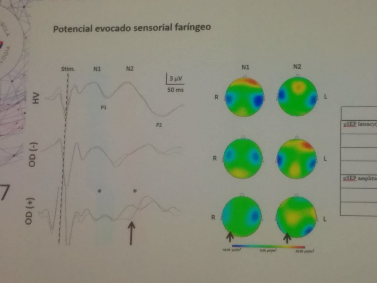 sdelgadoaros's tweet photo. #Disfagia #orofaringea  #ictus #isquémico HMataró. Estimulación cortical disminuïda tras estímulo faríngeo, 1/2 #AEG17 https://t.co/TTJsJata7C