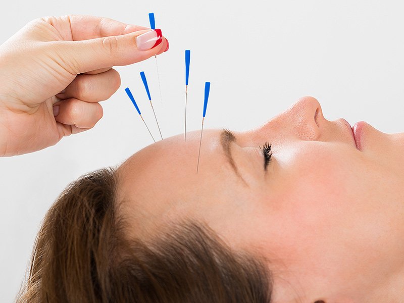 Medscape's tweet photo. A randomized clinical trial found #acupuncture reduces #migraine frequency, days with migraine, and pain intensity https://t.co/4Mlpp5ajSr https://t.co/Z85AFG2T7h