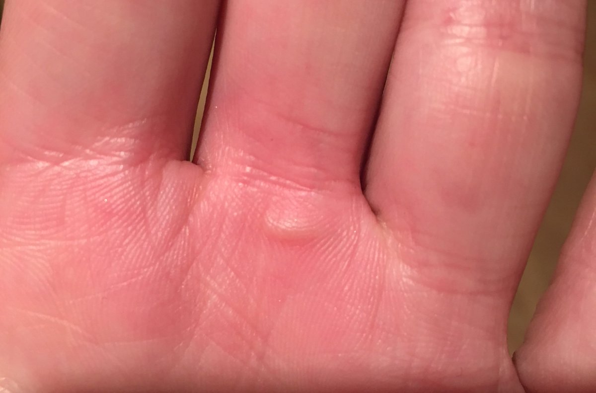 newmissannie's tweet photo. Eww😷 ouch! That would be why I don't normally stay in gym that long @ADV_PT https://t.co/r73oQPYIn6